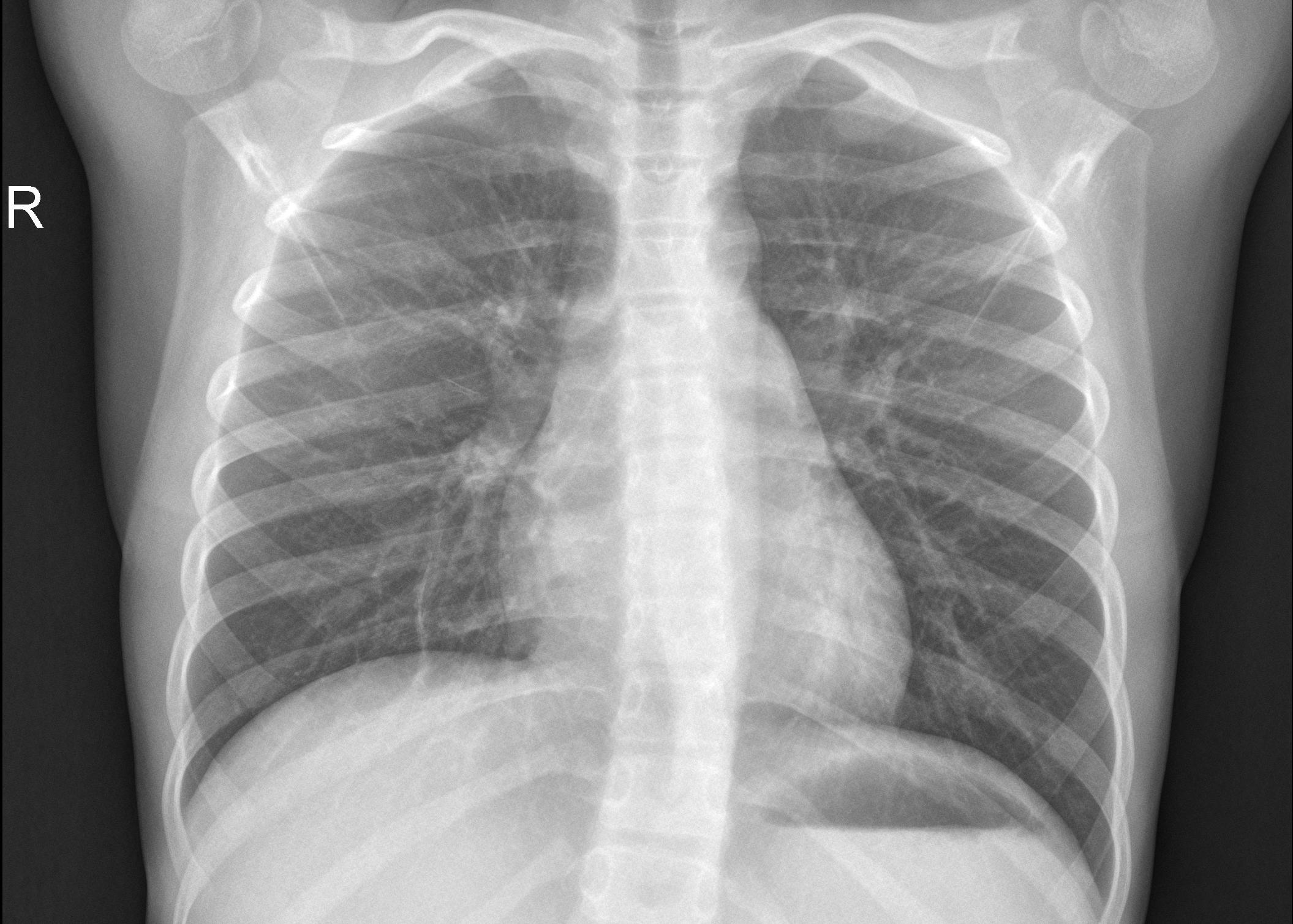 An image of a chest X-ray
